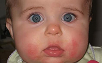 宝宝口水疹是湿疹吗 宝宝口水疹是什么引起的